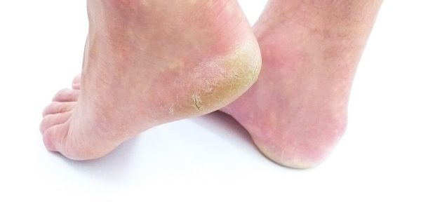 pieds vus de derrière avec la peau abimée